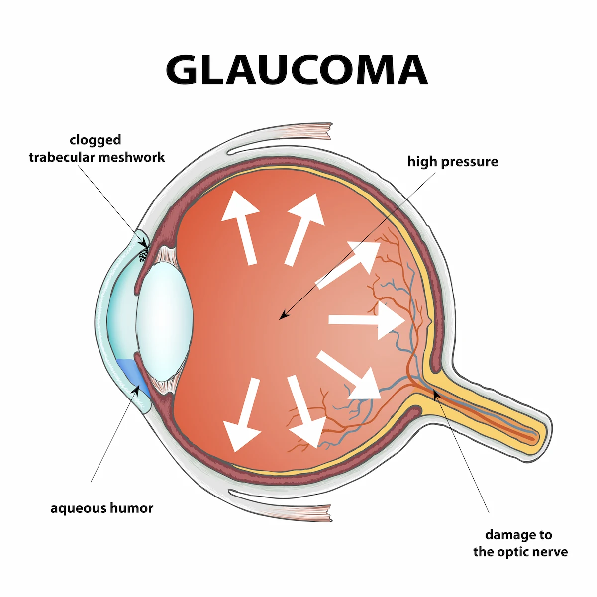 Glaucoma illustration