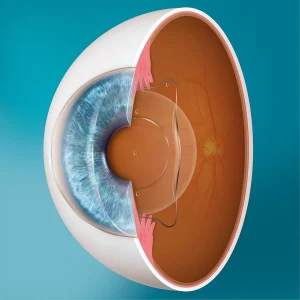 Evo Lens illustration